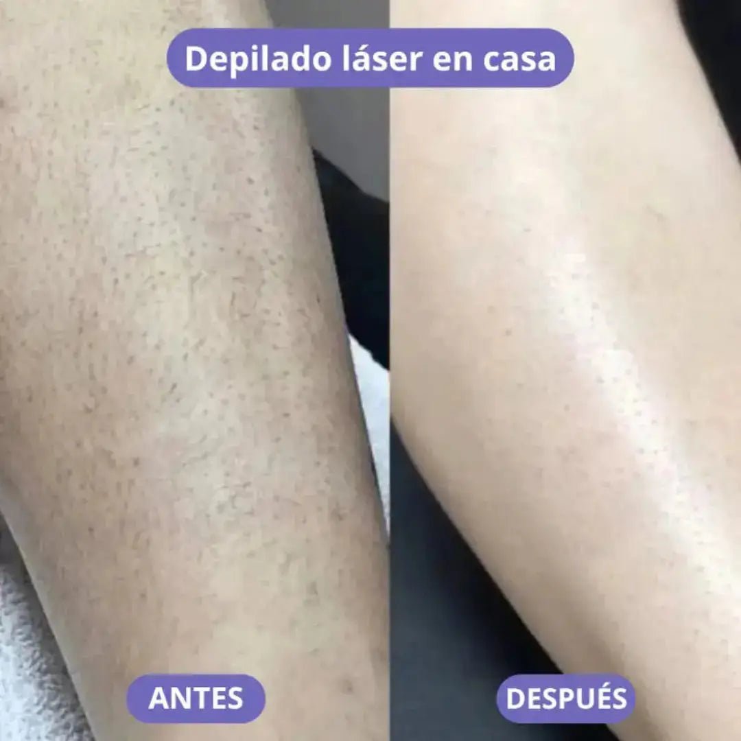 LisseLáser - Dile Adiós a los Vellos Indeseados 🌸
