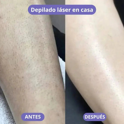 LisseLáser - Dile Adiós a los Vellos Indeseados 🌸