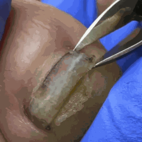DermaPatch Pro Parches antifúngico para hongos (21 Unidades) - Imagen 7